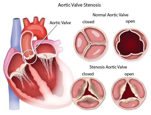 Normal Aortic Valve, Calcified Aortic Stenosis, and TAVR Procedure